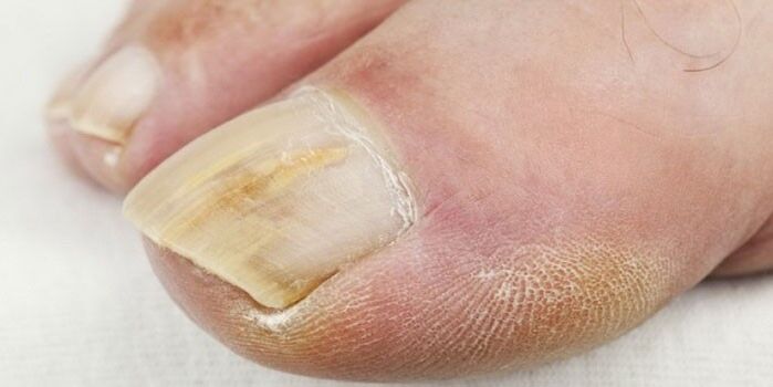 nail fungus symptoms