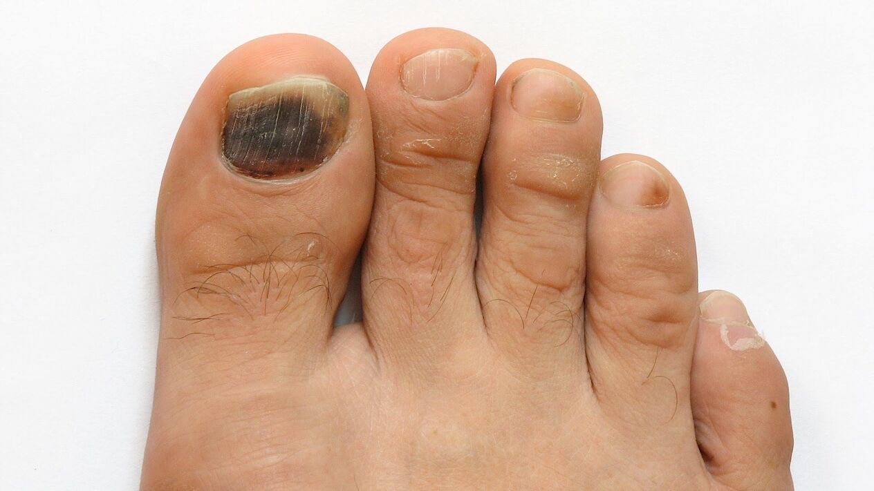 symptoms of fungus on big toe photo 2