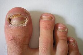 fungus on the nails