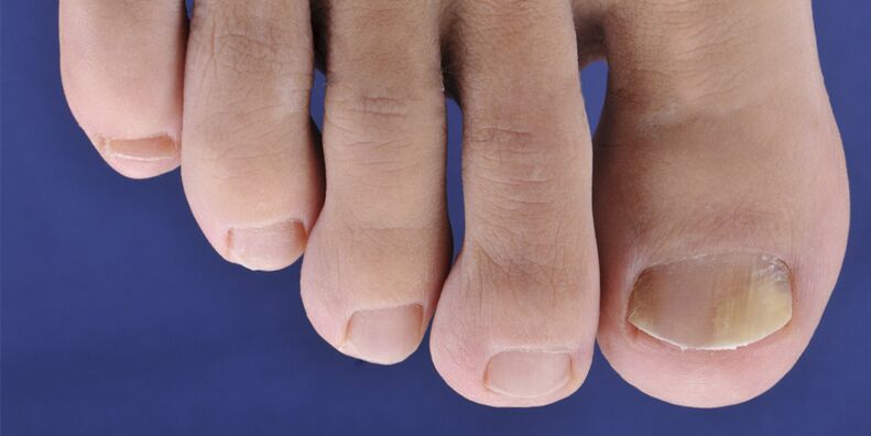 Symptoms of skin fungus and nail plates