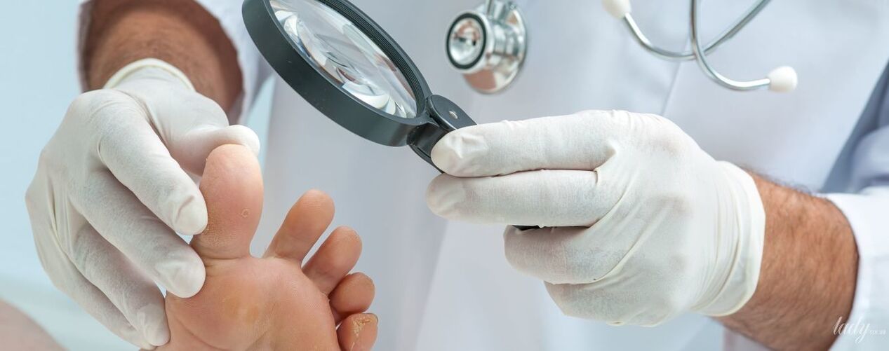 The doctor examines the fungus on the finger