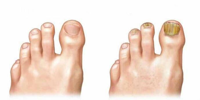 How the fungus looks like on the nails
