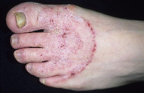 Feet and nail fungus