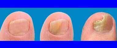 Stages of Development of the Fungus on the toes