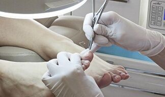 Surgical nail removal in Fungus