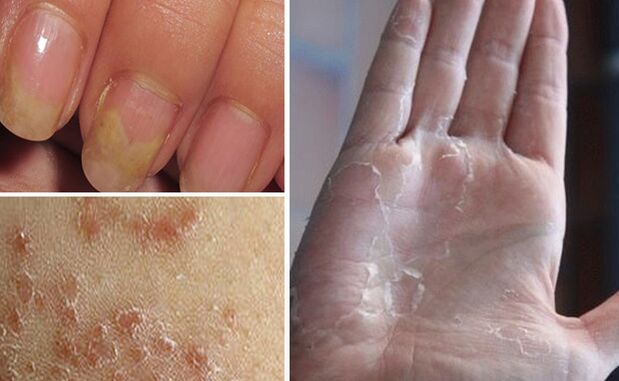 Can fungus go to other parts of the body