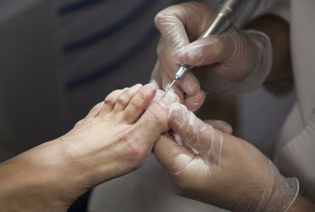 Diagnosis of the feet fungus