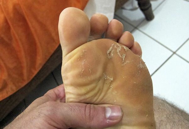 fungus on the skin of the feet