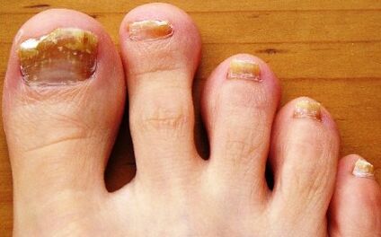 toenails affected by fungus;