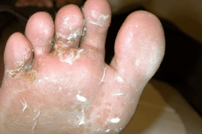 toe and toe fungus