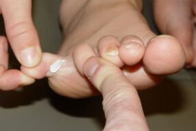 toe fungus