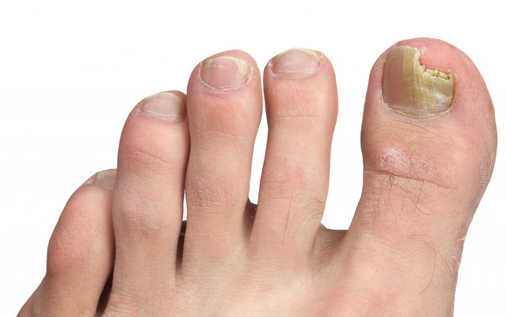 stages of nail fungus